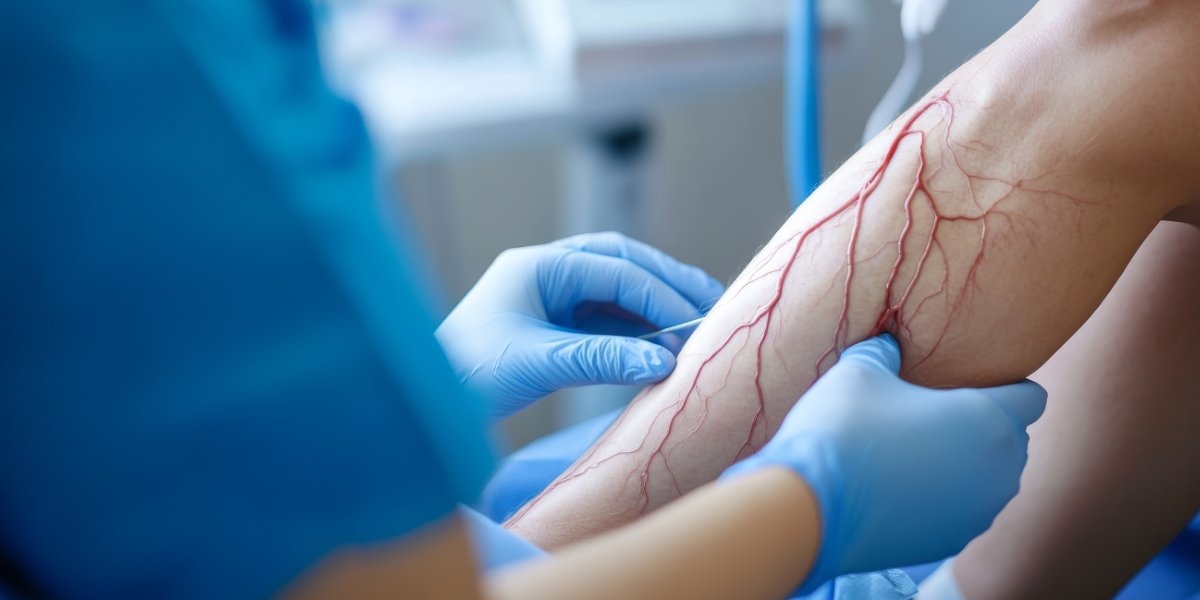 Diagnosing Peripheral artery disease