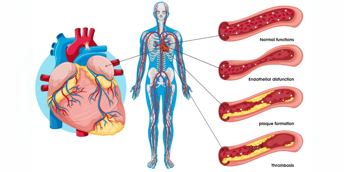 coronary artery disease vs peripheral artery differences