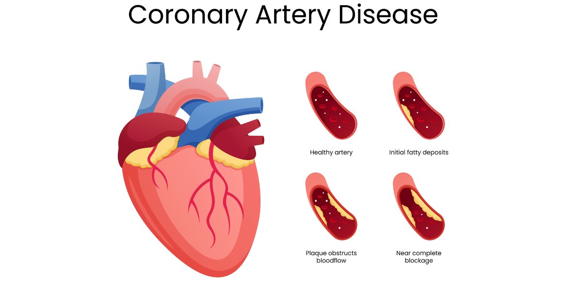 coronary artery disease