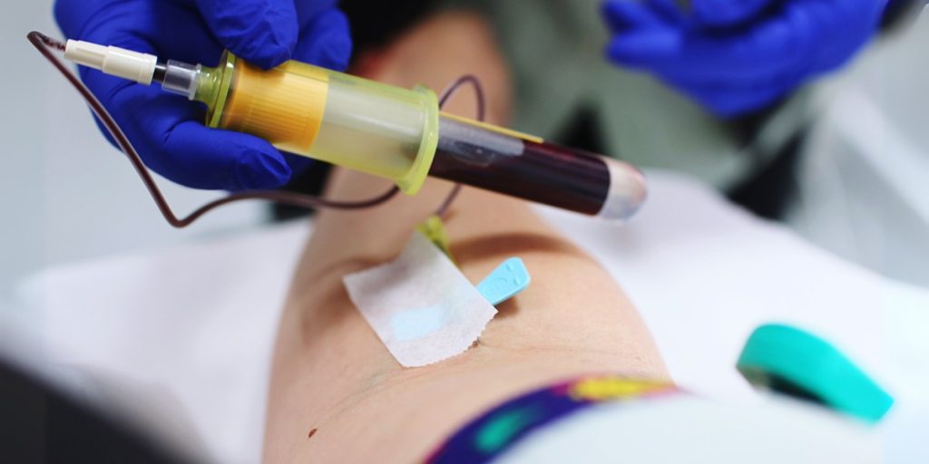 How To Remove Trapped Blood After Sclerotherapy?