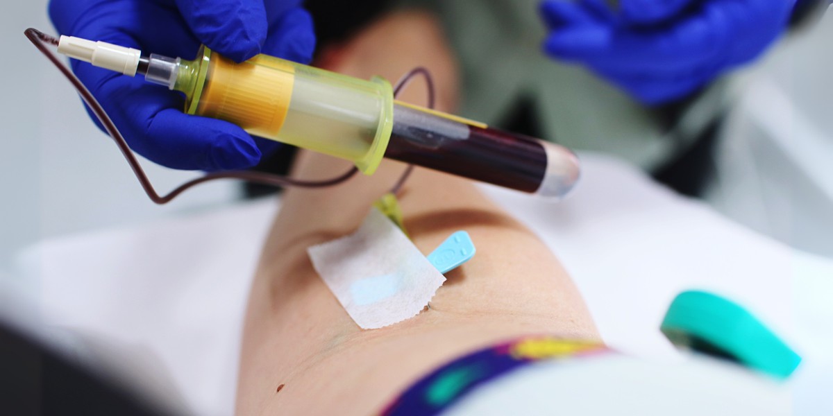 how to remove trapped blood after sclerotherapy