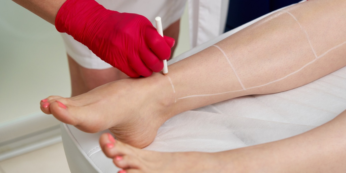 natural ways to reduce the appearance of spider veins