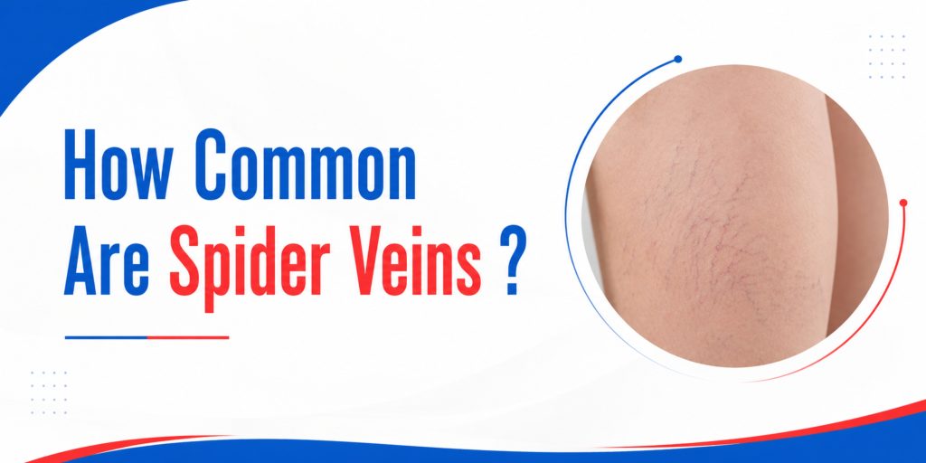 How Common Are Spider Veins ?