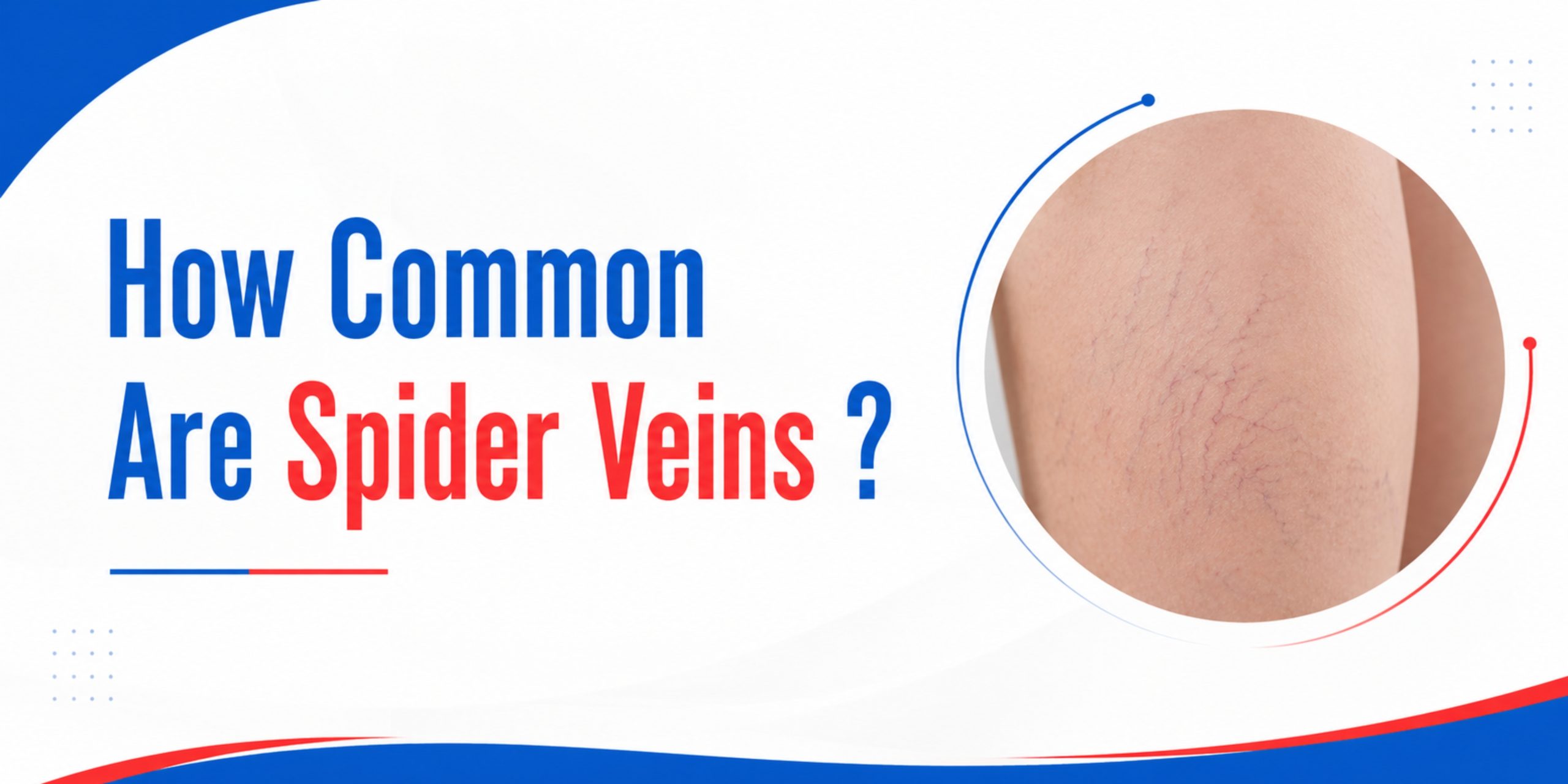 how common are spider veins